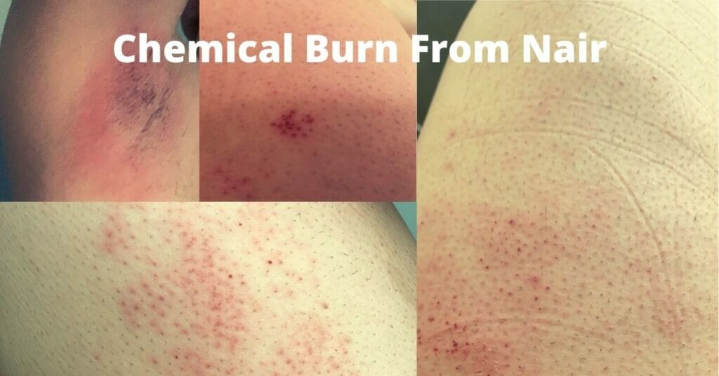 Chemical Burn From Nair